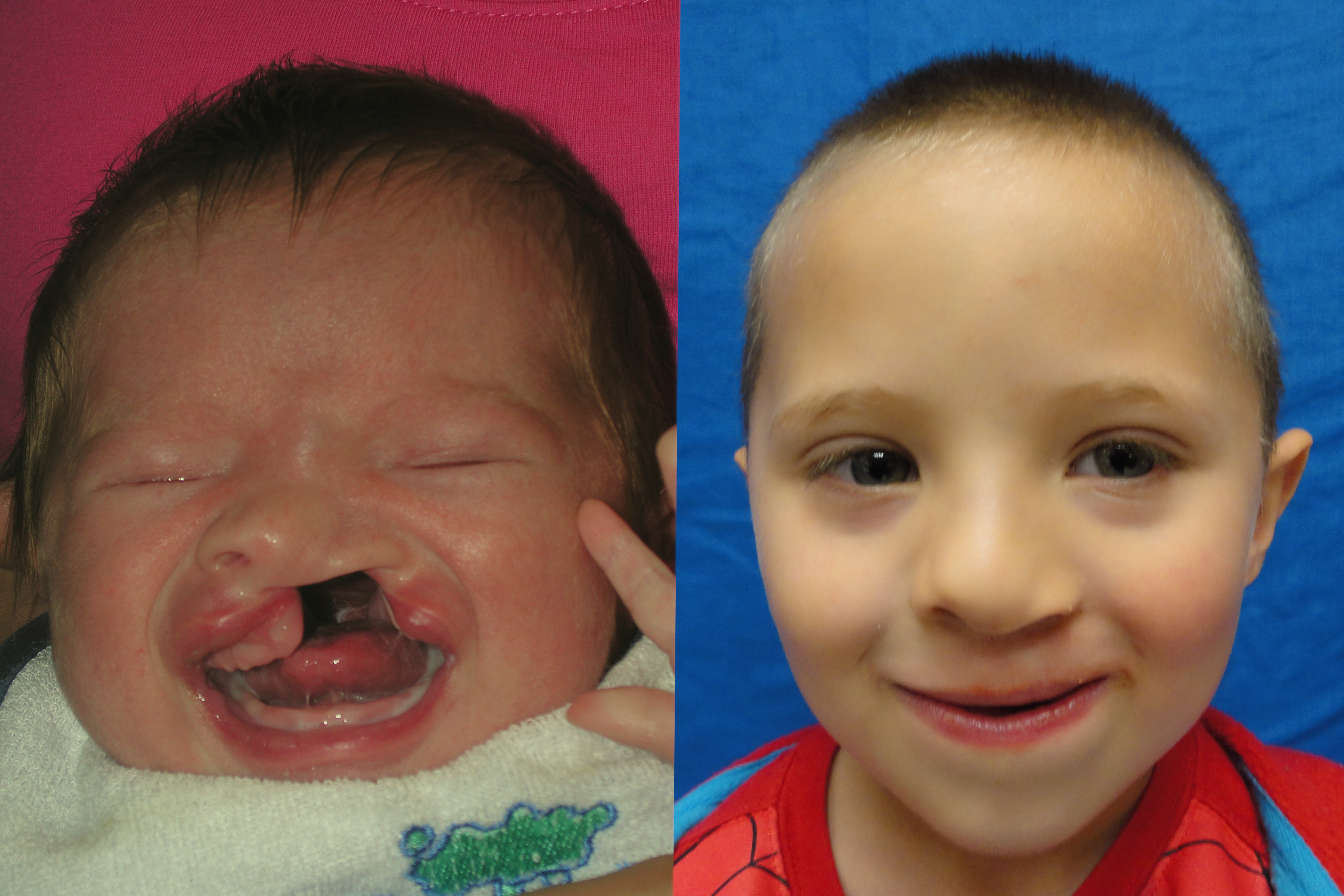 Cleft Lip and Palate
