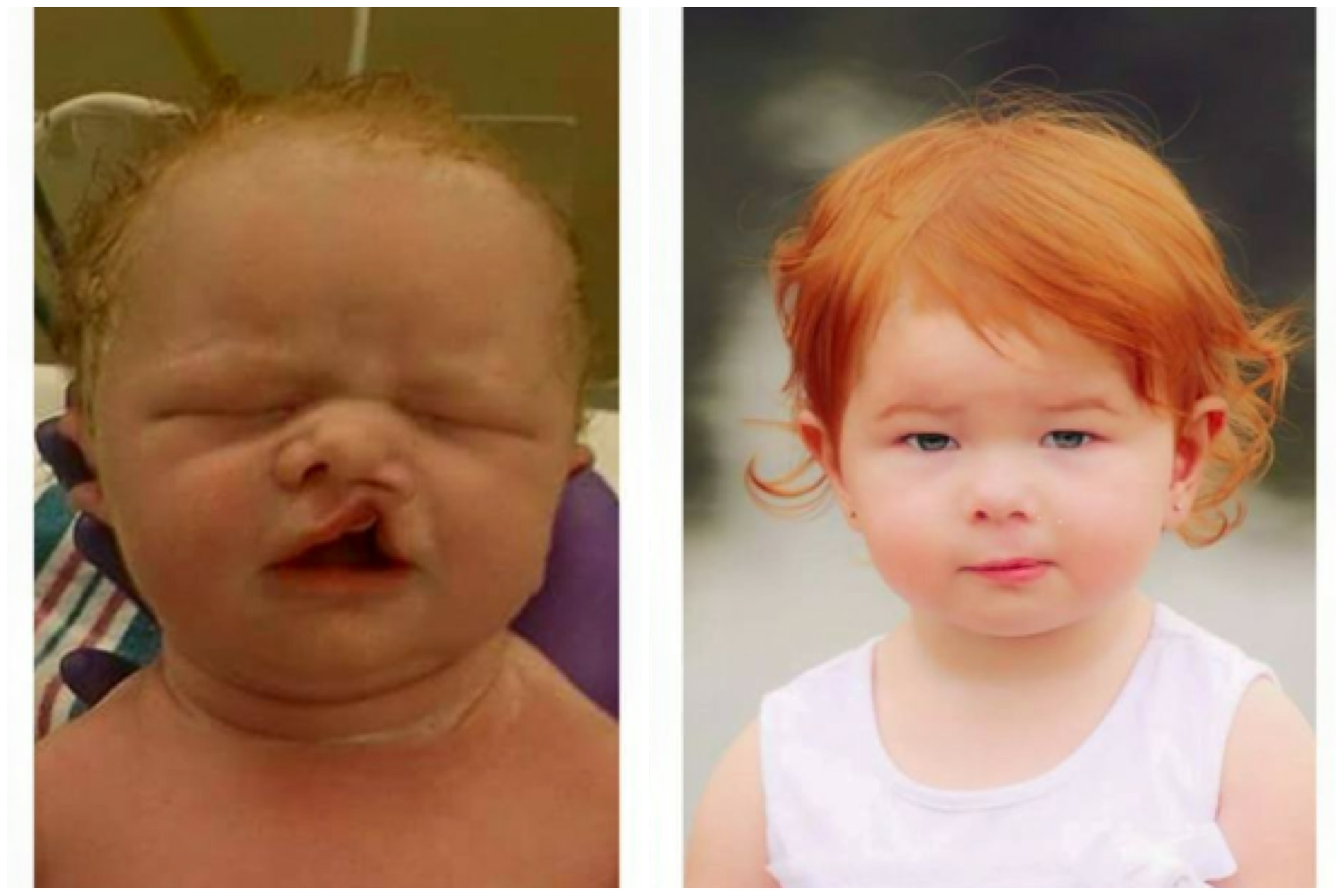 Cleft Lip and Palate