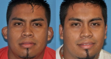 Otoplasty