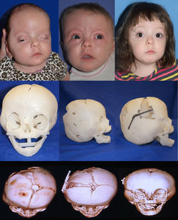 3-D Coronal Craniosynostosis