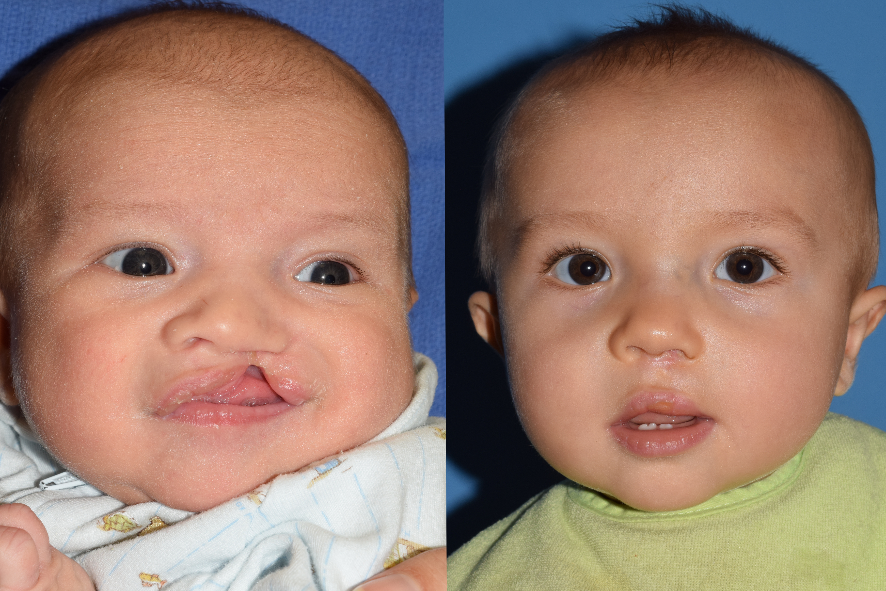 Cleft Lip and Palate