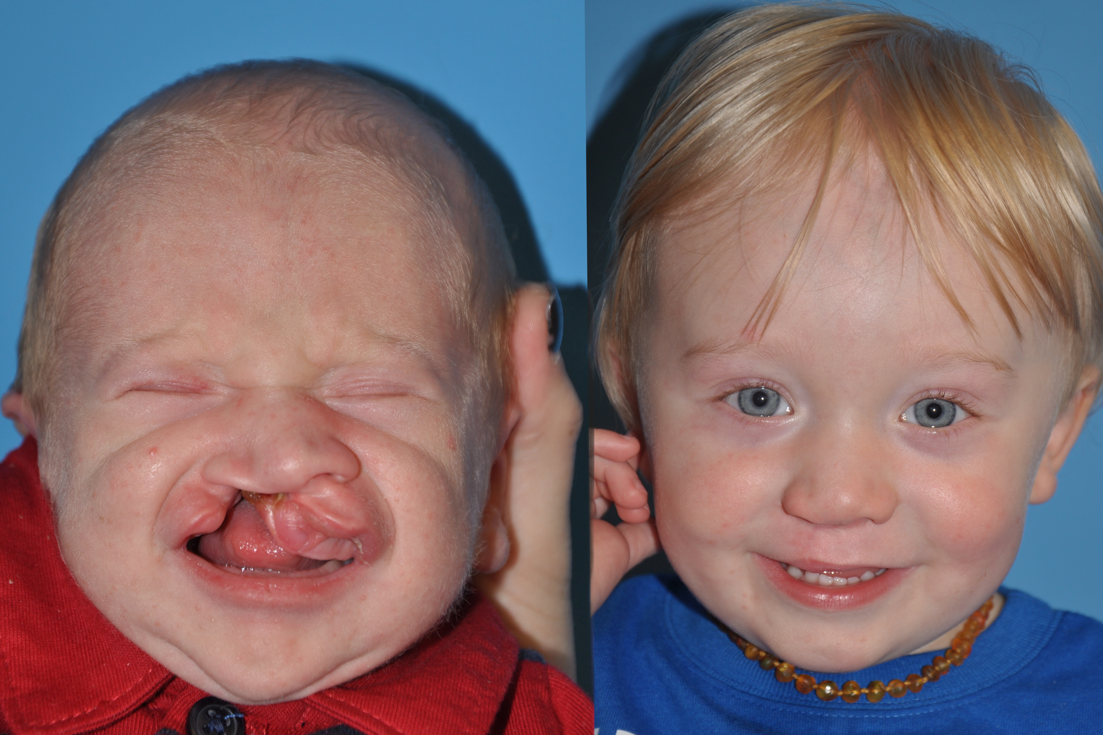 Cleft Lip and Palate