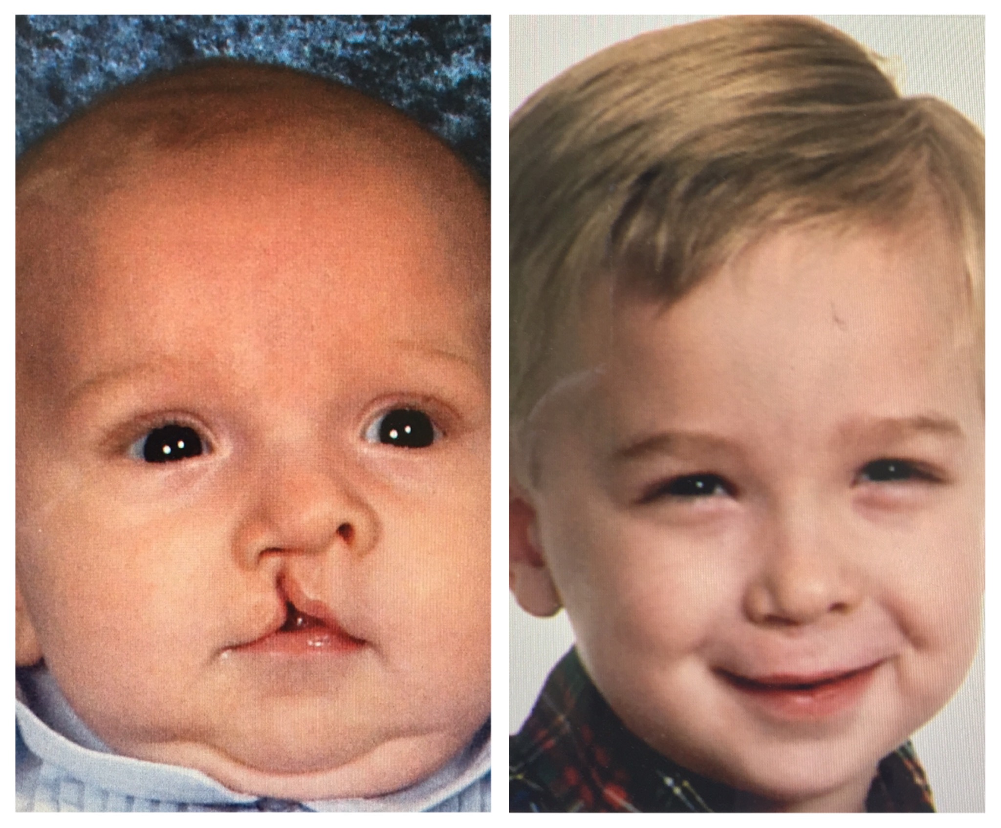 Cleft Lip and Palate