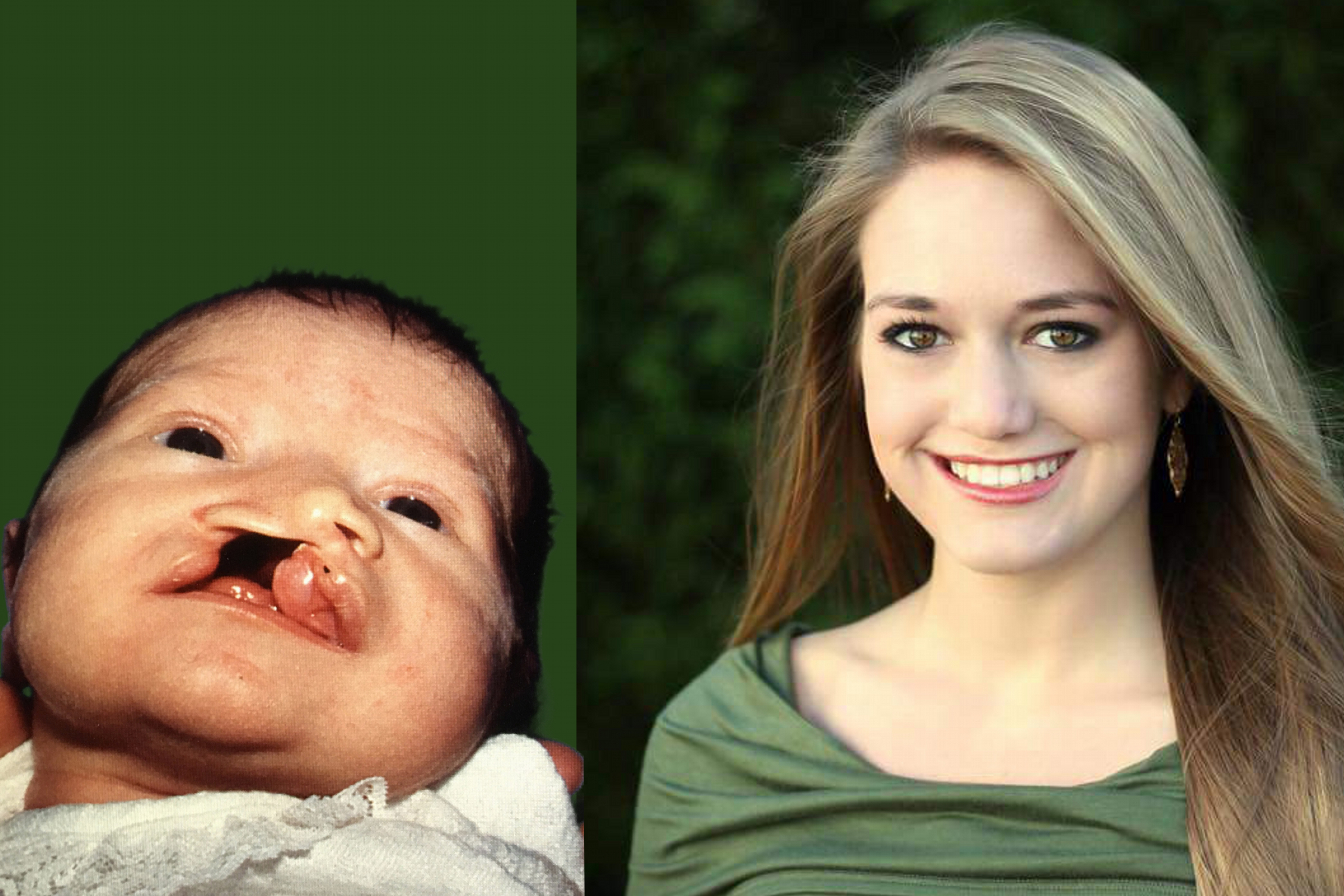 Cleft Lip and Palate