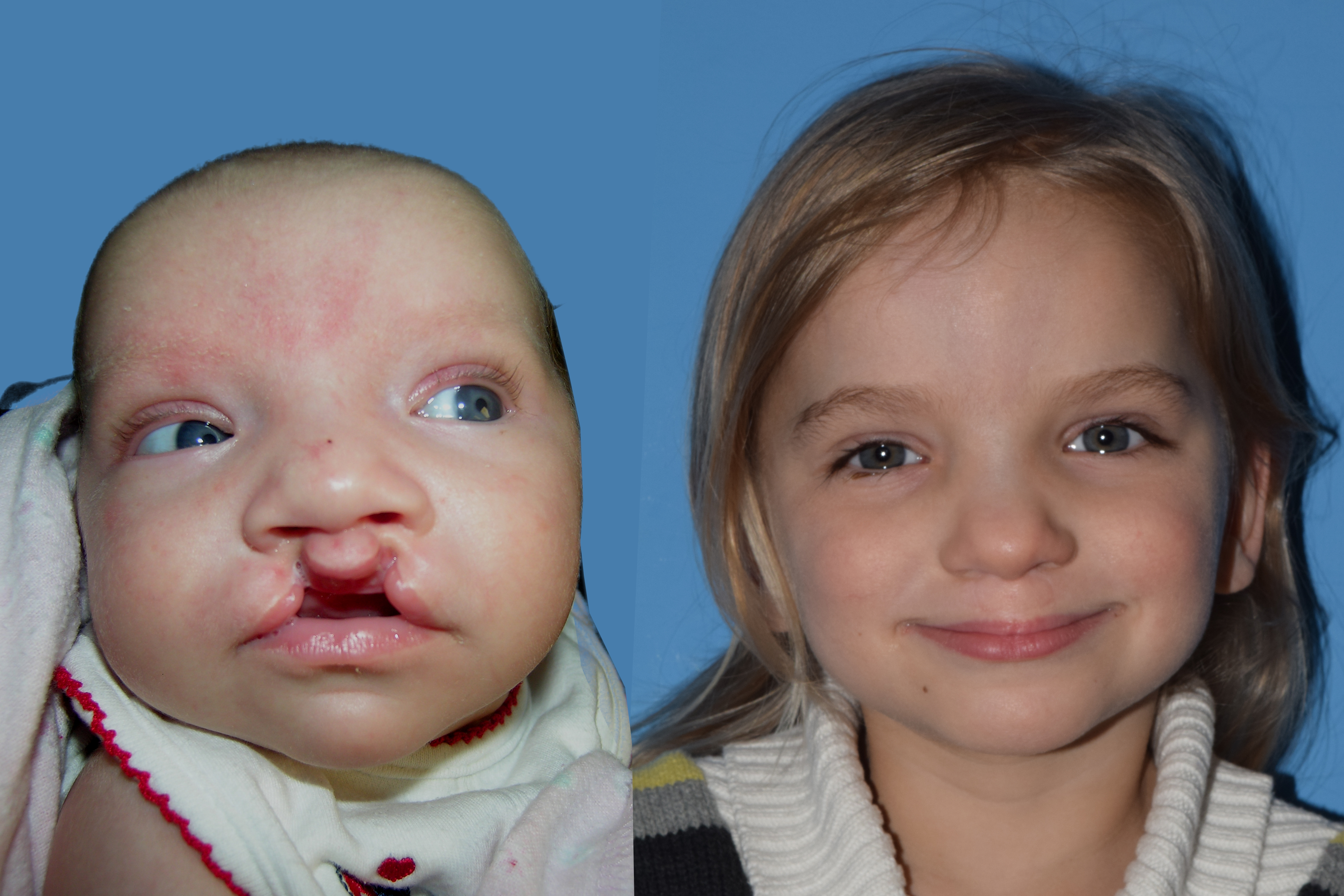 Cleft Lip and Palate