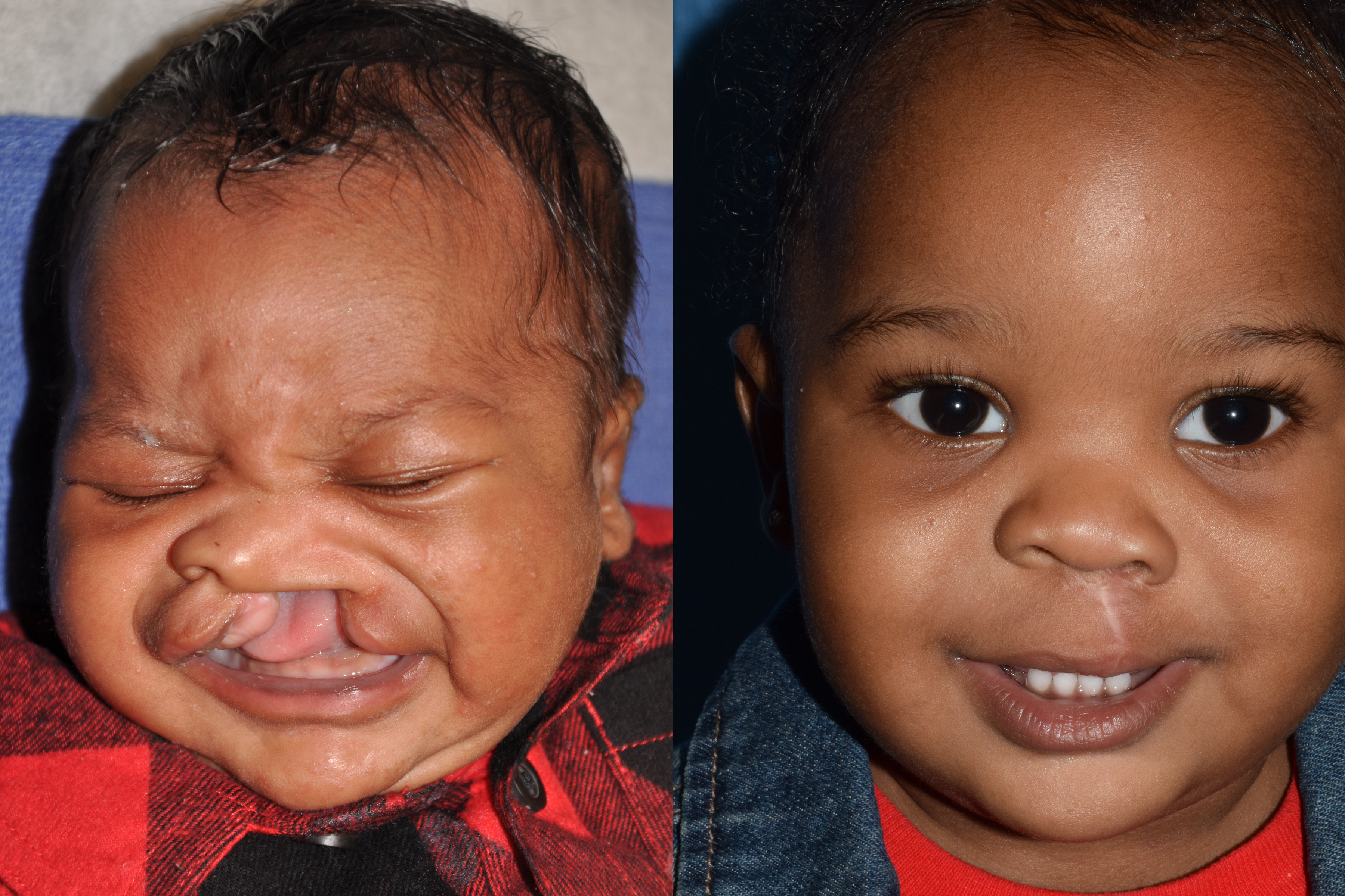 Cleft Lip and Palate