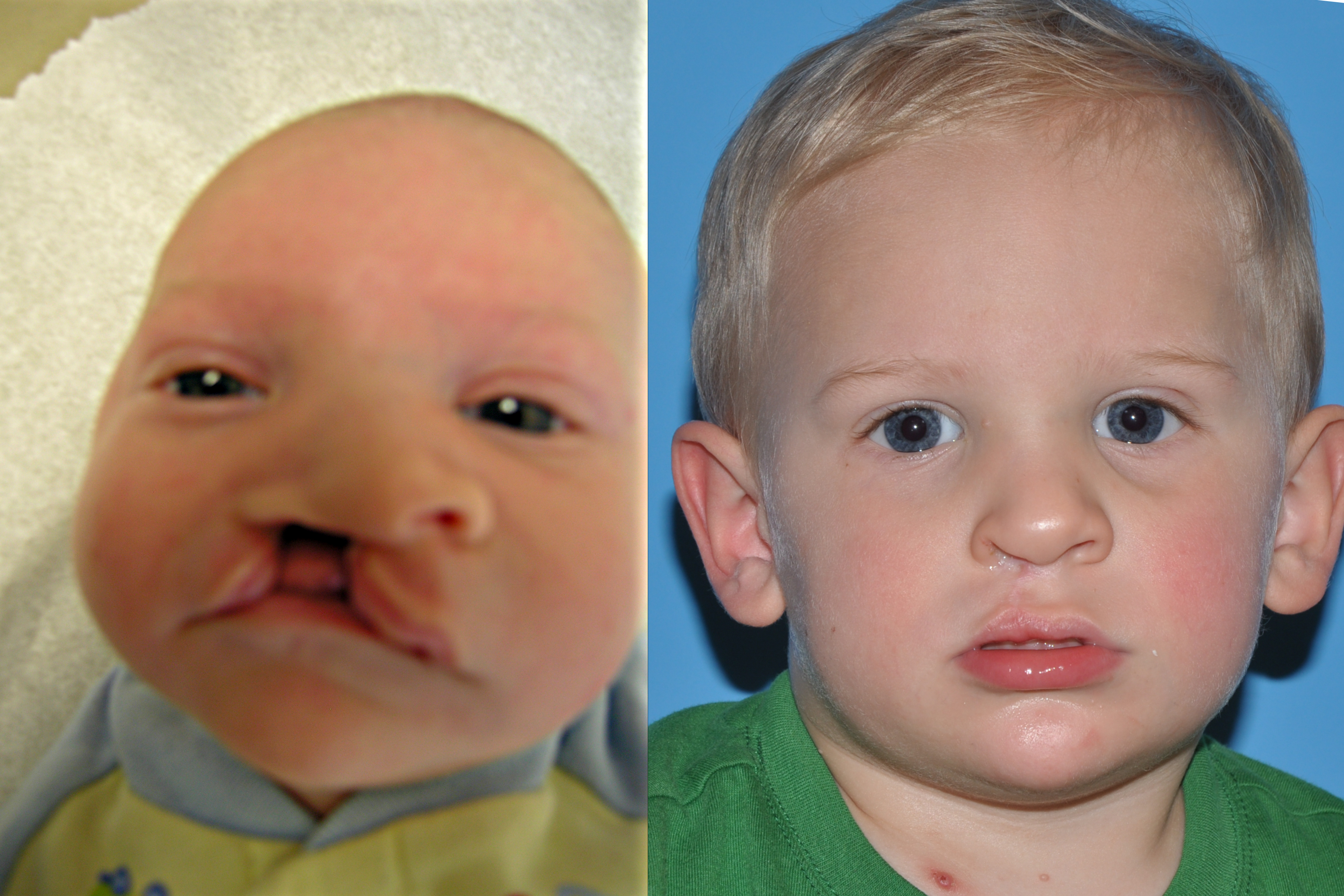 Cleft Lip and Palate
