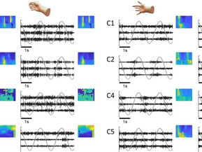 A direct spinal cord-computer interface enables the control of the paralysed hand in spinal cord injury - Brain, 2024