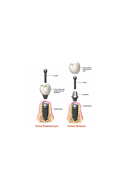 implant crown image 3.png