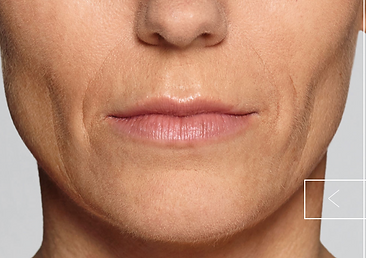 Restylane Defyne Laugh Line Results Befo