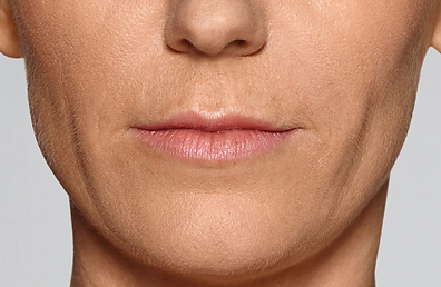 Restylane Defyne Laugh Line Results_ Bef