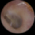 Clear ear canal with visible eardrum