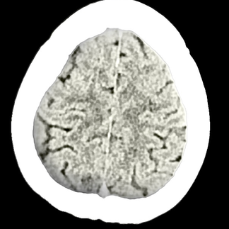 Depression CT Scan CTFOD 8