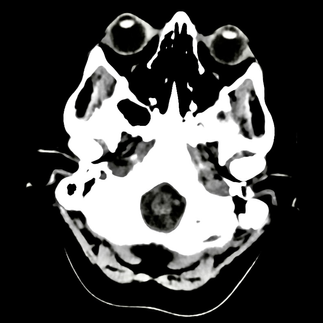 Depression CT Scan CTFOD 9