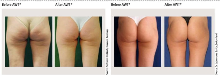 Before and After Cellulite