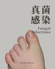 De Acupuncture x Herbs Centre: Treating common skin issue (fungal infection) with using TCM Treatment