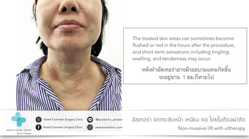 ulthera ภูเก็ต อัลเทอร่า ยกกระชับหน้าไม่ต้องผ่าตัด