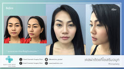 เสริมจมูก rhinoplasty รีวิวเสริมจมูก