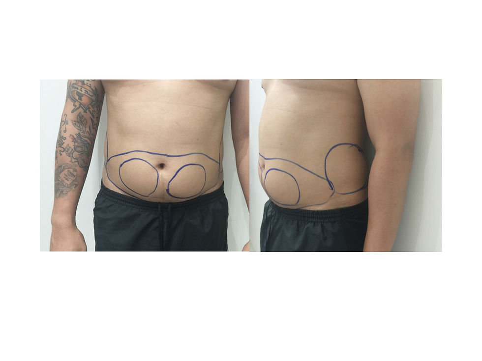 ดูดไขมันภูเก็ต bodyjet liposuction