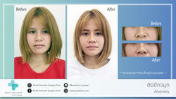 เสริมจมูก rhinoplasty รีวิวเสริมจมูก