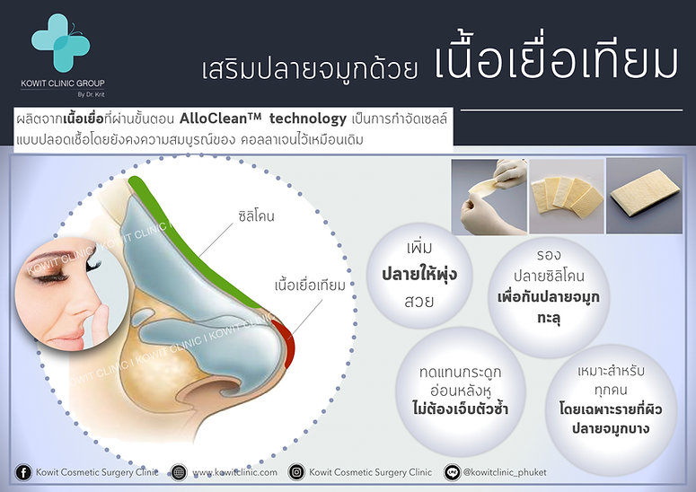 เสริมปลายจมูกด้วยเนื้อเยื่อเทียม กันปลายจมูกทะลุ