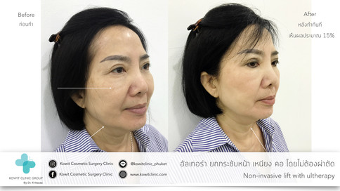 ulthera ภูเก็ต อัลเทอร่า ยกกระชับหน้าไม่ต้องผ่าตัด