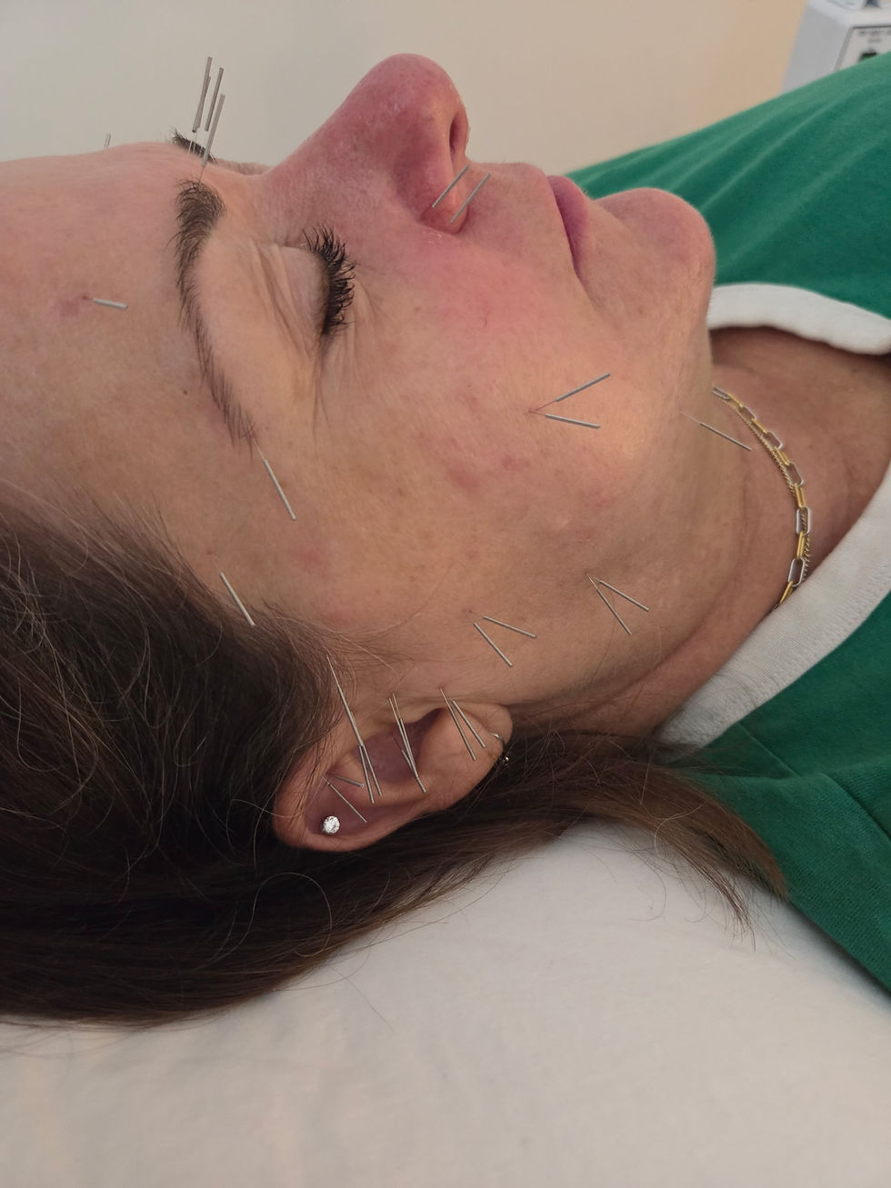 Acupuncture Isn't Just for Glowing Skin: 5 Surprising Ways It Can Support Your Health