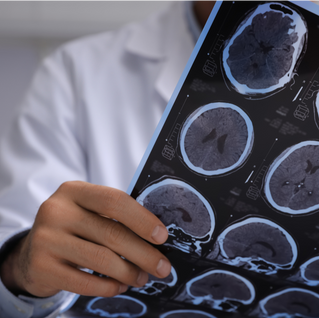 Unravelling the Mystery: Functional Neurological Disorder vs. Conversion Disorder