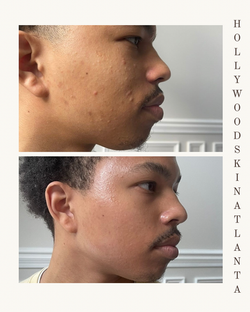 Green and Beige Minimalist Skincare Before After Collage Instagram Post