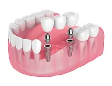 Dental Implants at Park Road Dental