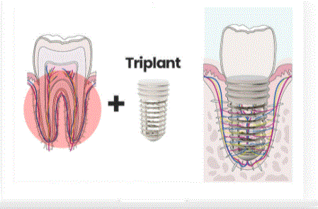 triplant.GIF