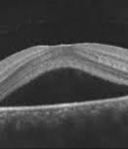 central serous retinopathy