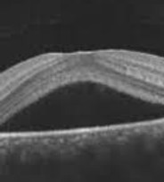 Central serous retinopathy-csr