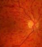 Retina vein occlusion
