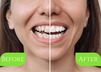 before and after veneers