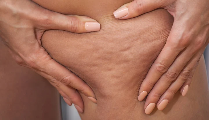 17694-cellulite-607252182.webp