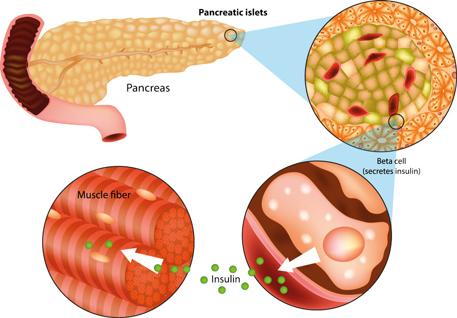Thumbnail: Bio-Energetic Diabetes (Type 2) Reversal / Remission Belt.