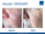 EXCELIGHT - Vascular Facial Vessels
