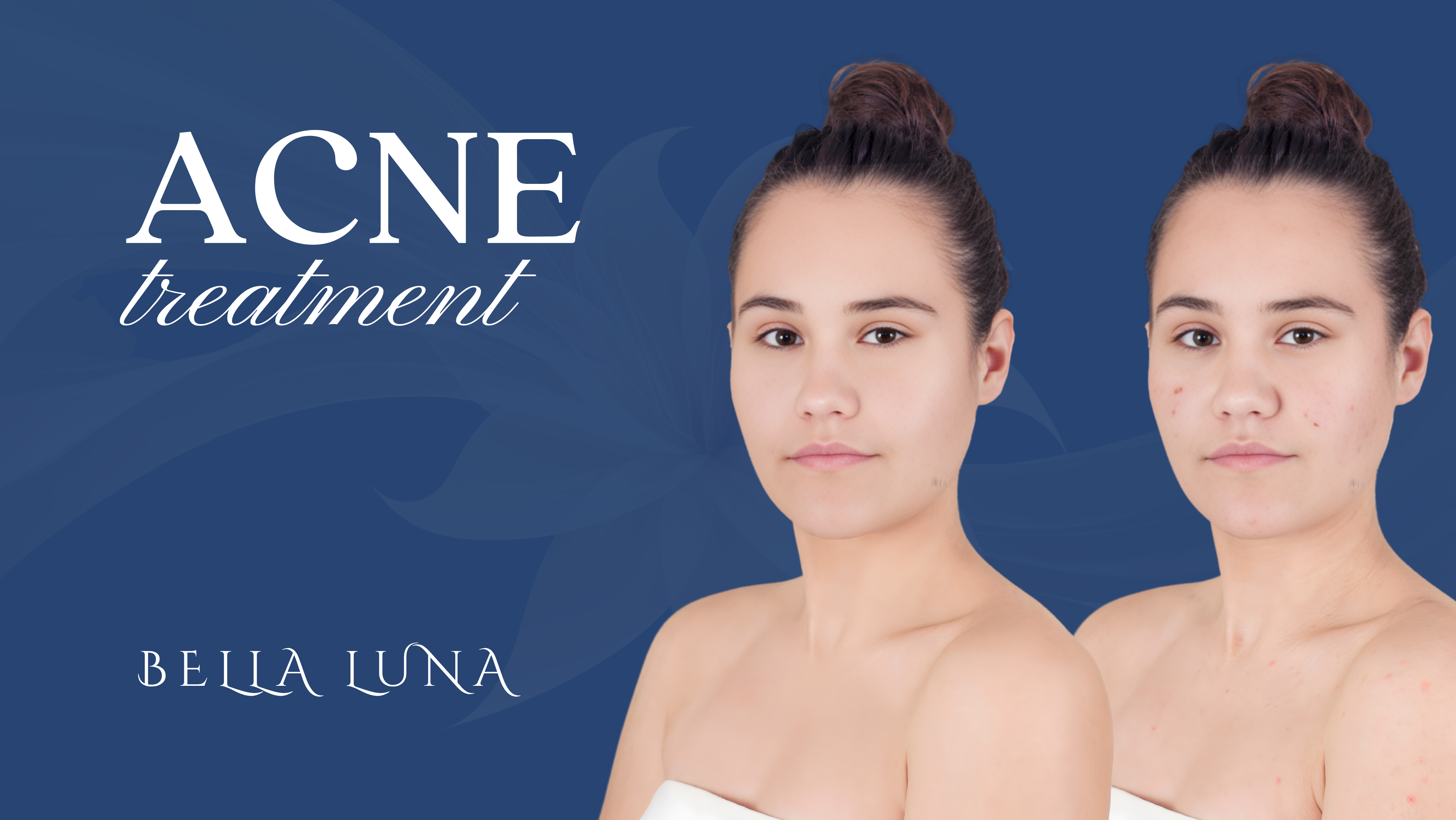 AcneTreatment