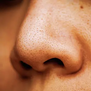Blackheads, whiteheads