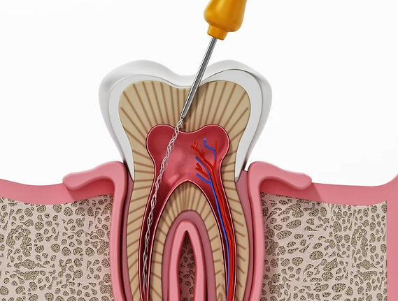 Root Canal.jpg