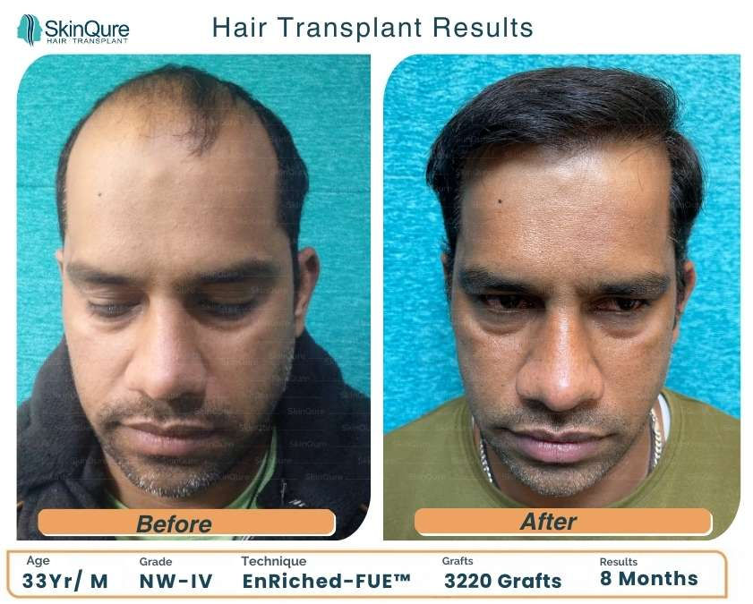 hair transplant results in delhi