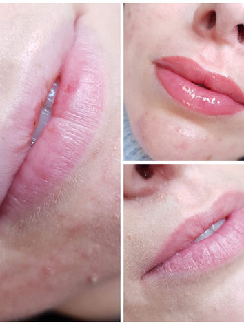 Fordyce Drüsen Pmu Permanent make up Lippen - medizinische pigmentierung , Pmu Profi Ingol