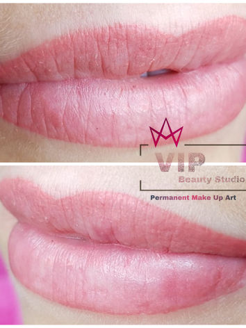 Fordyce Drüsen Pmu Permanent make up Lippen - medizinische pigmentierung , Pmu Profi Ingol