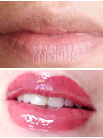 Fordyce Drüsen Pmu Permanent make up Lippen - medizinische pigmentierung , Pmu Profi Ingol