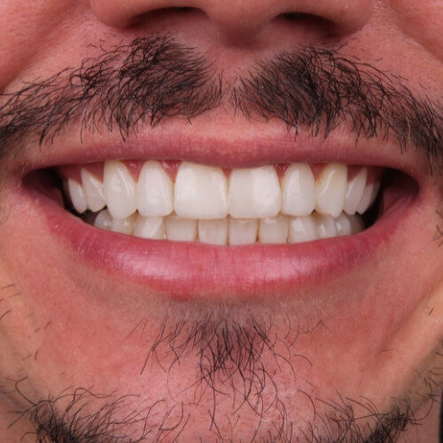 lente-de-contato-facetas-em-porcelana-resina-vilamariana-paraiso-sp-rizsa-odontologia.jpg