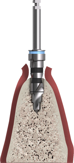 SECUENCIA PROTOCOLO QUIRÚRGICO