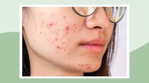 The Psychology of Visible Skin Conditions