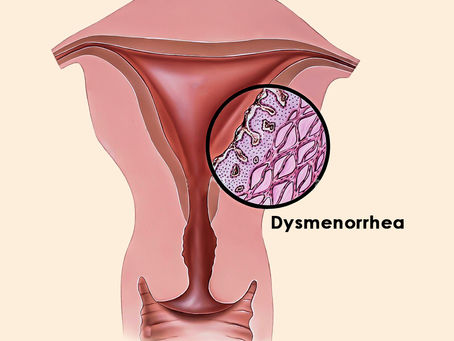 Dysmenorrhea Types Causes Symptoms Diagnosis & Treatment