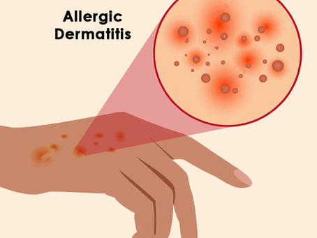 Allergic Dermatitis Types Causes Symptoms & Treatment